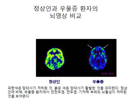 정상인과 우울증 환자의 뇌영상 비교 사진(정산인, 우울증 비교 사진) 파란색은 당대사가 저하된 것, 붉은 색은 당대사가 활발한 것을 의미한다. 정상인에 비해, 우울증 환자에서 전전두엽, 전두엽, 기저핵 부위의 뇌활성이 저하된 것을 보여준다.